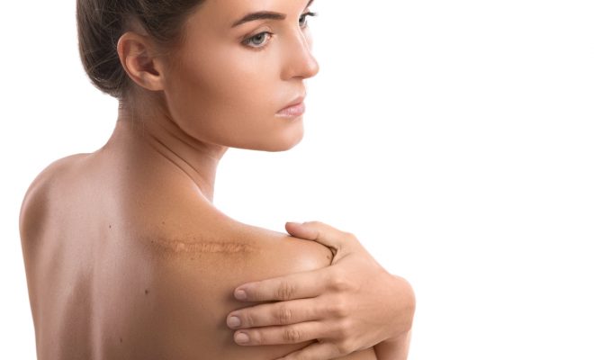 Woman with a scar on her shoulder over white background